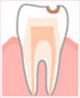 ・エナメル質の虫歯　C1