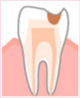 ・象牙質（神経を守る層）の虫歯　C2