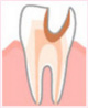 ・神経（歯髄）まで進んだ虫歯　C3